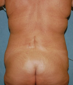 Body Lift Patient 56396 Before Photo # 7