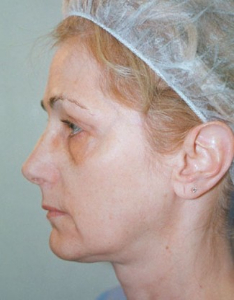 Eye Lift - Blepharoplasty Patient 66523 Before Photo # 1