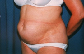 Tummy Tuck Patient 19101 Before Photo # 3