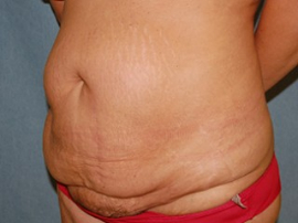 Body Lift Patient 56396 Before Photo # 3
