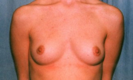 Breast Augmentation Patient 35218 Before Photo # 1