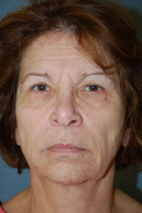 Eye Lift - Blepharoplasty Patient 52177 Before Photo # 1