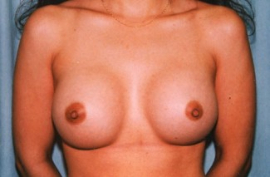 Breast Augmentation Patient 16566 After Photo # 2