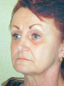 Eye Lift - Blepharoplasty Patient 14431 After Photo # 6