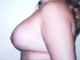 Breast Augmentation and Lift Patient 31205 After Photo # 2