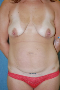 Breast Enhancement and Tummy Tuck Patient 81426 Before Photo # 1