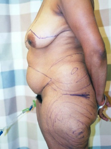 Breast Enhancement and Tummy Tuck Patient 83357 Before Photo # 1