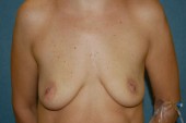 Breast Augmentation Patient 97222 Before Photo # 1