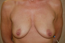 Breast Augmentation Patient 42926 Before Photo # 1