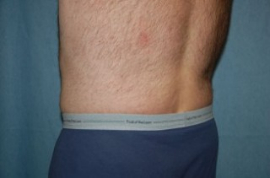 Body Lift Patient 45266 After Photo # 4