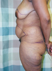 Breast Enhancement and Tummy Tuck Patient 22589 Before Photo # 1