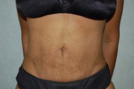 Liposuction Patient 62658 After Photo # 2