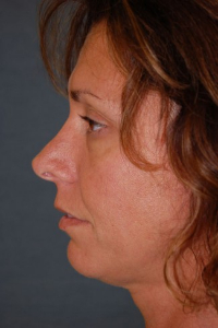 Chin Augmentation Patient 83833 Before Photo # 3
