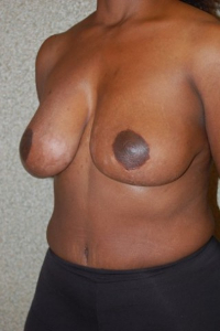 Breast Enhancement and Tummy Tuck Patient 39346 After Photo # 4