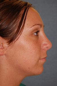 Chin Augmentation Patient 68370 After Photo # 8