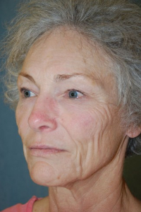 Face Lift and Neck Lift Patient 89542 Before Photo # 5
