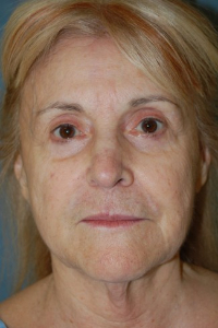 Eye Lift - Blepharoplasty Patient 27828 Before Photo # 1