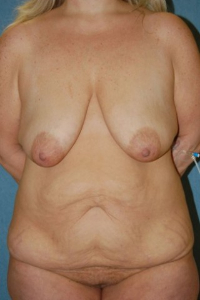 Breast Enhancement and Tummy Tuck Patient 16498 Before Photo # 1