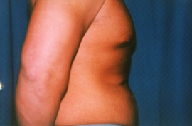 Tummy Tuck - Men Patient 43311 Before Photo # 3