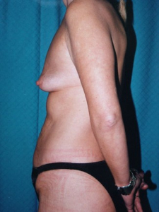 Breast Enhancement and Tummy Tuck Patient 11052 Before Photo # 3
