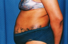 Tummy Tuck Patient 26227 Before Photo # 5