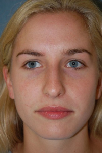 Rhinoplasty Patient 65711 Before Photo # 1