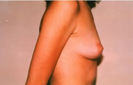 Breast Augmentation Patient 39680 Before Photo # 3