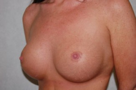 Breast Augmentation Patient 34919 After Photo # 4