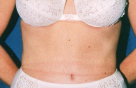 Tummy Tuck Patient 15918 After Photo # 2