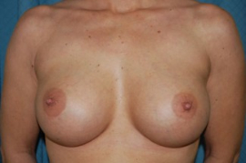 Breast Augmentation Patient 89092 After Photo # 2