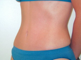 Mini Tummy Tuck Patient 74818 After Photo # 4