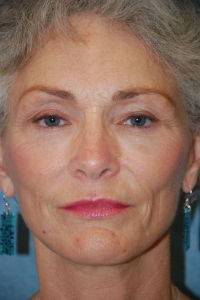 Face Lift and Neck Lift Patient 89542 After Photo # 2