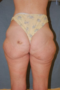 Body Lift Patient 69575 Before Photo # 3