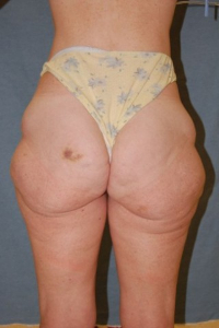 Body Lift Patient 69575 Before Photo # 3