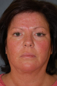 Face Lift and Neck Lift Patient 15871 Before Photo # 1