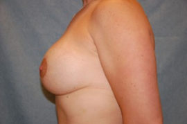 Breast Augmentation and Lift Patient 28581 After Photo # 4