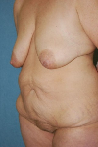 Tummy Tuck Patient 74016 Before Photo # 3
