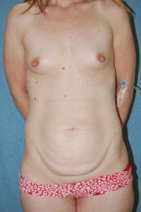 Breast Enhancement and Tummy Tuck Patient 79050 Before Photo # 1