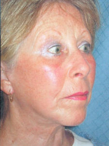 Injectables Patient 27314 After Photo # 4