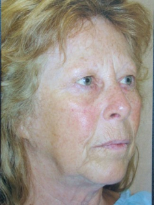 Injectables Patient 27314 Before Photo # 3