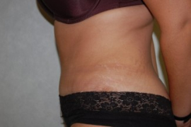 Tummy Tuck Patient 56117 After Photo # 6