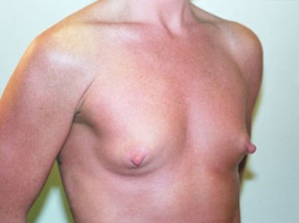 Breast Augmentation Patient 43878 Before Photo # 1