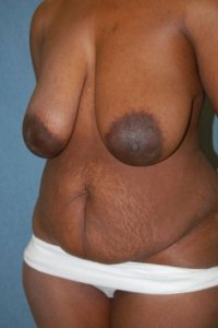 Breast Enhancement and Tummy Tuck Patient 39346 Before Photo # 3