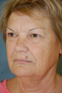 Eye Lift - Blepharoplasty Patient 93559 Before Photo # 3