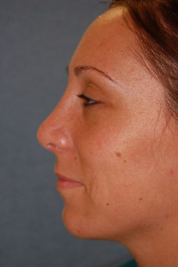 Chin Augmentation Patient 68370 After Photo # 4