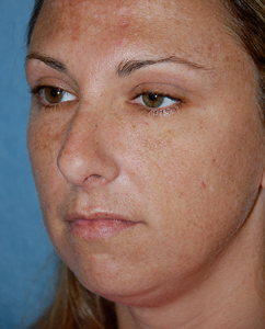 Rhinoplasty Patient 70122 Before Photo # 3