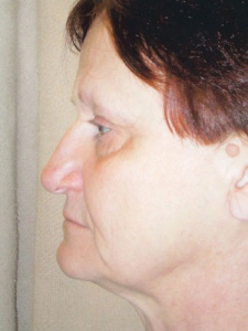 Eye Lift - Blepharoplasty Patient 14431 Before Photo # 1