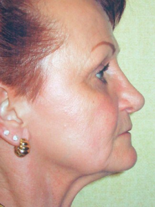 Eye Lift - Blepharoplasty Patient 14431 After Photo # 4