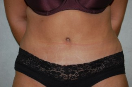 Tummy Tuck Patient 56117 After Photo # 2