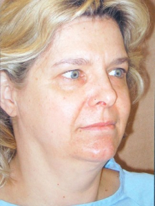 Eye Lift - Blepharoplasty Patient 37019 Before Photo # 3